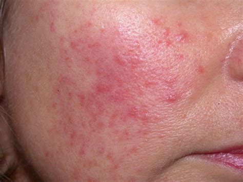 red rash on face cheeks.